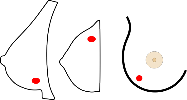 Brustknoten Lage Schema